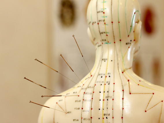 акупунктура, иглоукалывание