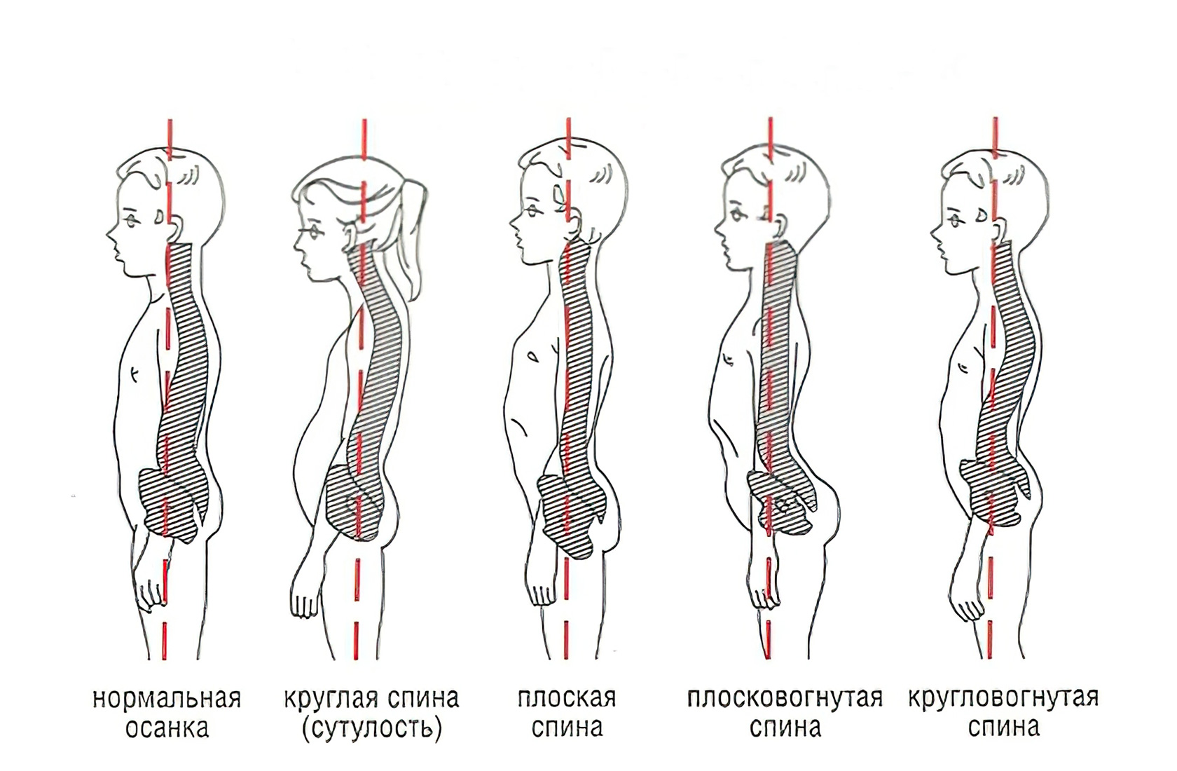 Прямая поясница