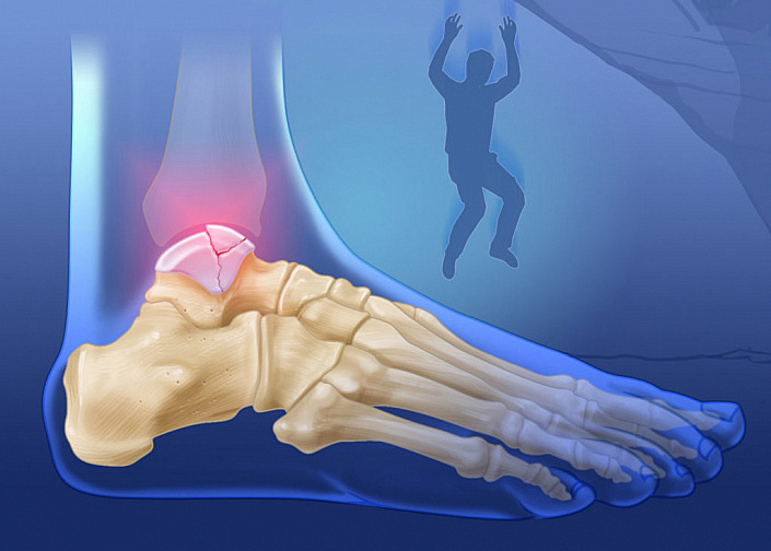 перелом стопы в разрезе