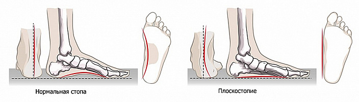 отклонения от нормы в стопе