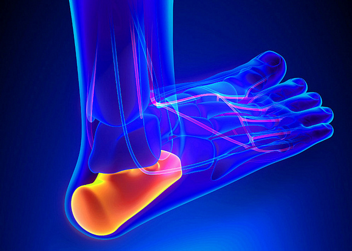 пяточная шпора в разрезе