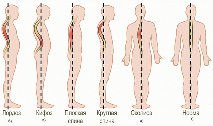 виды искривления позвоночника