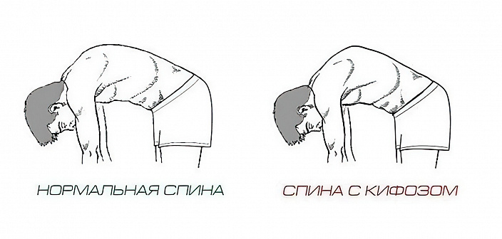 тест на кифоз