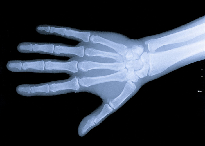 рентген кисти