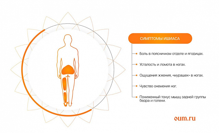симптомы ишиаса